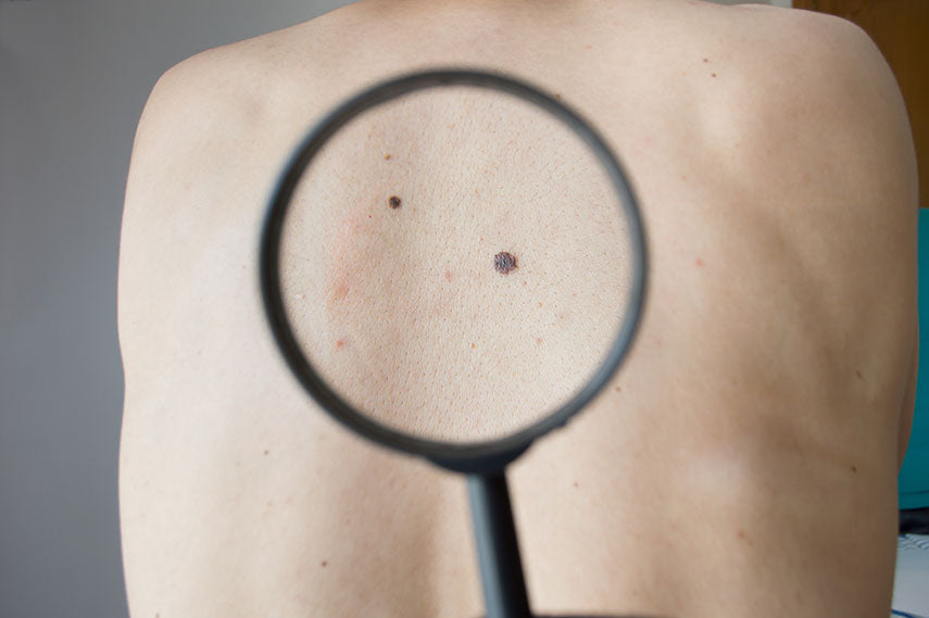 checking melanoma on back