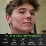 Level 2: The TiegeClear® ACNE Advanced Routine